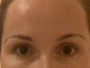 before and after eyebrows procedure | NYC