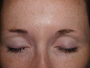 before and after eyebrows procedure | New Yor City