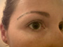before and after eyebrows procedure in Miami, Florida