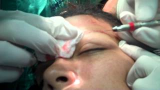 Explanation of Creating Natural Appearing Eyebrow Transplant
