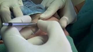 Female Eyebrow Transplant Surgery