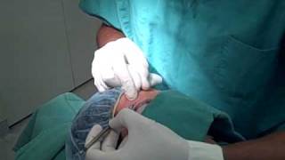 Plastic Surgeon / Eyebrow Transplant Procedure