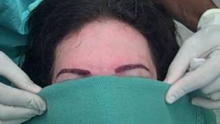 Plastic surgeon-female eyebrow transplant patient