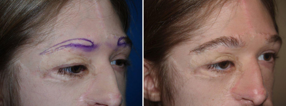 Eyebrow Transplantation before and after photos in Miami, FL, Patient 15965