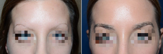 Eyebrow Transplantation before and after photos in Miami, FL, Patient 15665