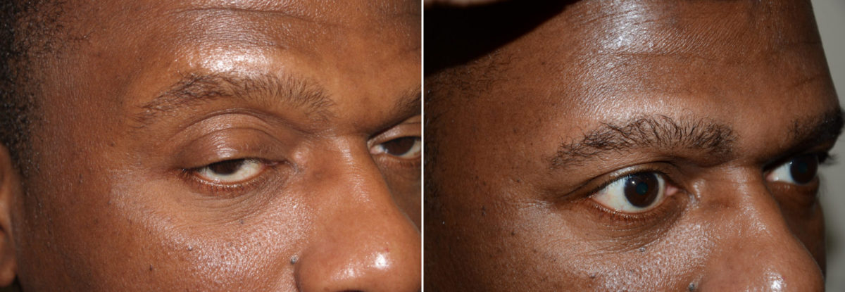 Eyebrow Transplantation before and after photos in Miami, FL, Patient 15672