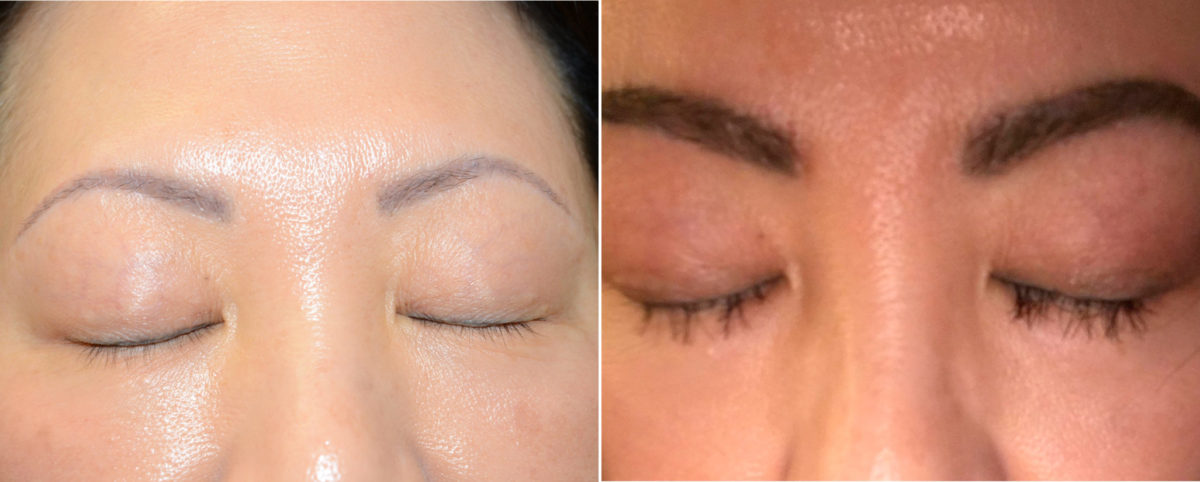 Eyebrow Transplantation before and after photos in Miami, FL, Patient 15679