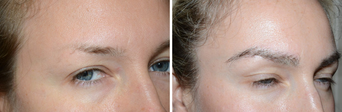 Eyebrow Transplantation before and after photos in Miami, FL, Patient 15682