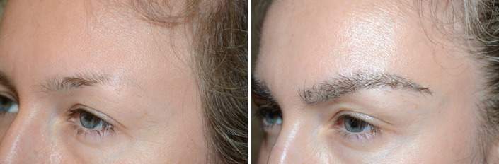 Eyebrow Transplantation before and after photos in Miami, FL, Patient 15682