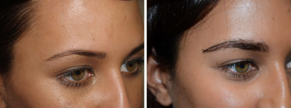 Eyebrow Transplantation before and after photos in Miami, FL, Patient 15691
