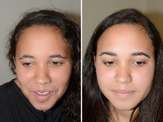 Eyebrow Transplantation before and after photos in Miami, FL, Patient 15698