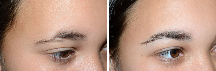Eyebrow Transplantation before and after photos in Miami, FL, Patient 15698
