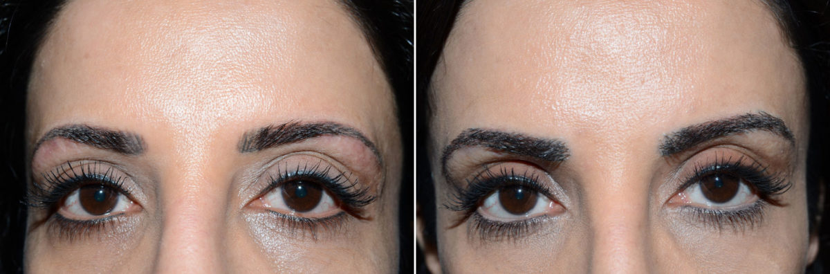 Eyebrow Transplantation before and after photos in Miami, FL, Patient 15707
