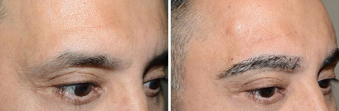 Eyebrow Transplantation before and after photos in Miami, FL, Patient 15713