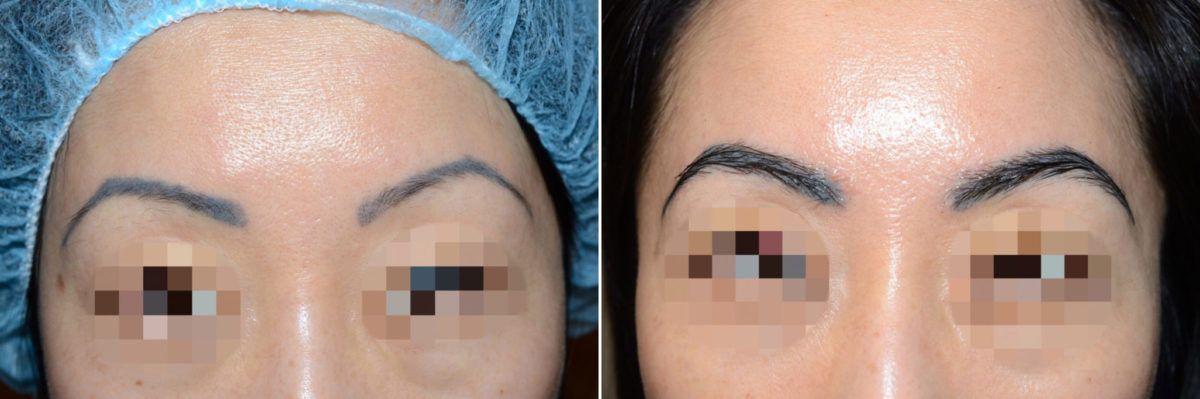 Eyebrow Transplantation before and after photos in Miami, FL, Patient 15720
