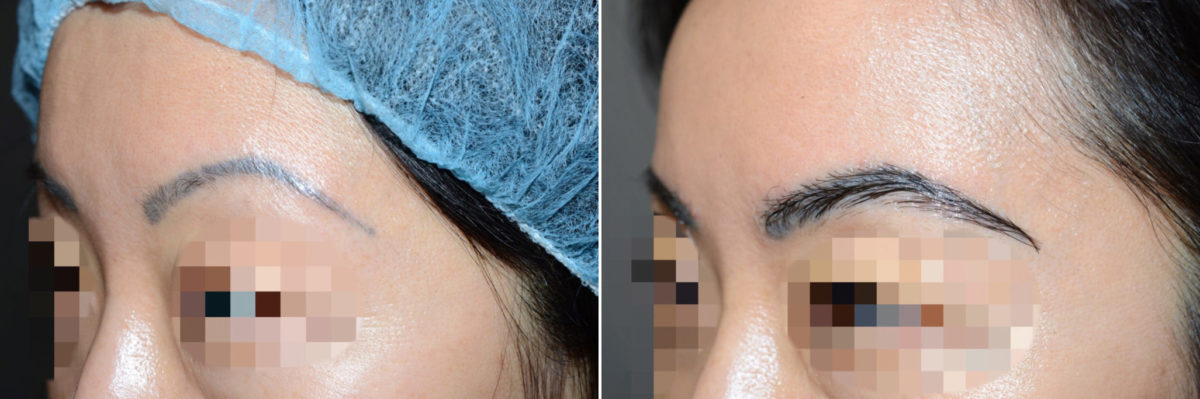 Eyebrow Transplantation before and after photos in Miami, FL, Patient 15720
