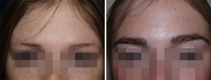 Eyebrow Transplantation before and after photos in Miami, FL, Patient 15734