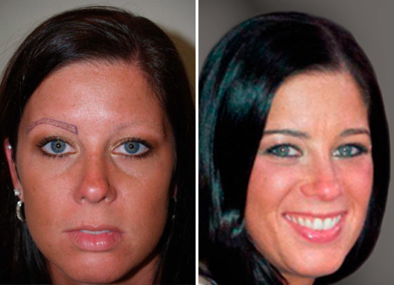 Eyebrow Transplantation before and after photos in Miami, FL, Patient 15746