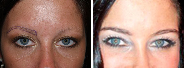 Eyebrow Transplantation before and after photos in Miami, FL, Patient 15746