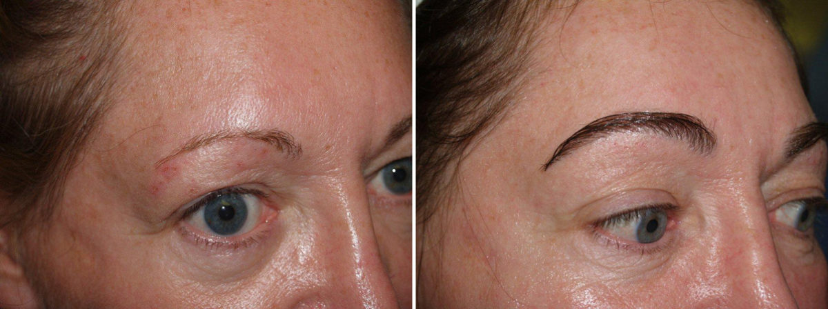 Eyebrow Transplantation before and after photos in Miami, FL, Patient 15751