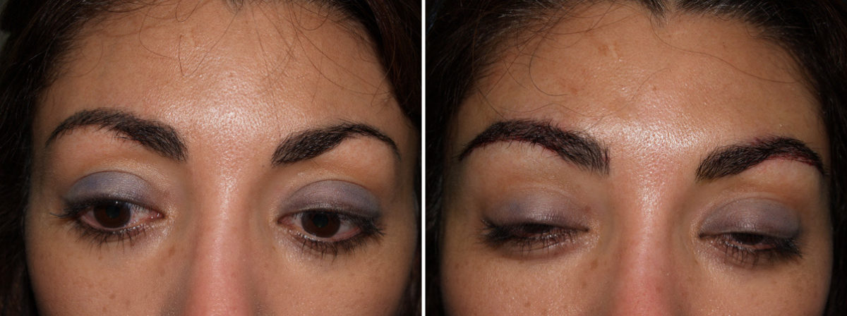 Eyebrow Transplantation before and after photos in Miami, FL, Patient 15756