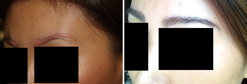 Eyebrow Transplantation before and after photos in Miami, FL, Patient 15761