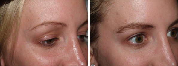 Eyebrow Transplantation before and after photos in Miami, FL, Patient 15768
