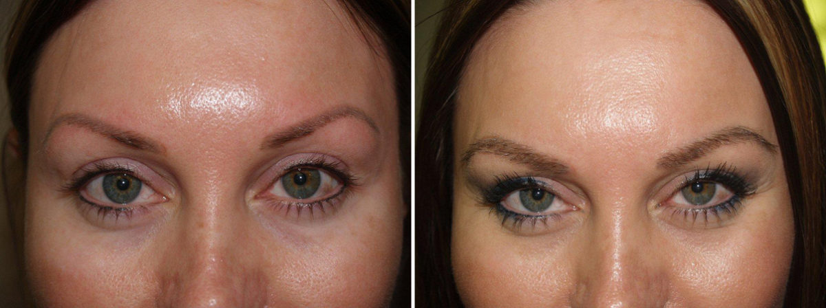 Eyebrow Transplantation before and after photos in Miami, FL, Patient 15775