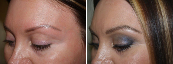 Eyebrow Transplantation before and after photos in Miami, FL, Patient 15775