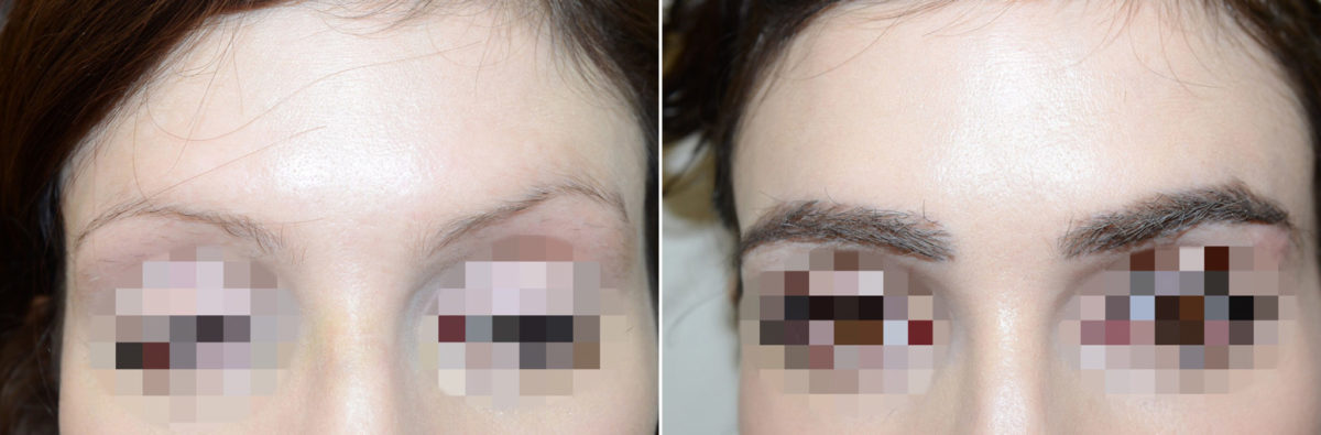 Eyebrow Transplantation before and after photos in Miami, FL, Patient 15780