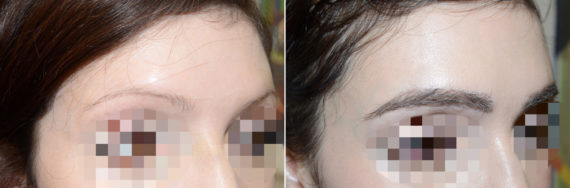 Eyebrow Transplantation before and after photos in Miami, FL, Patient 15780