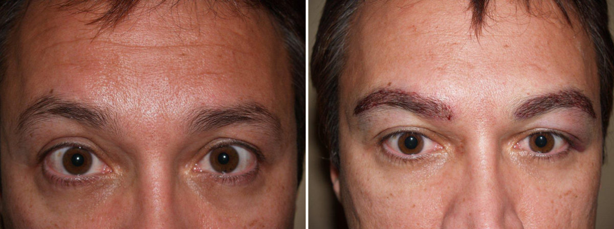 Eyebrow Transplantation before and after photos in Miami, FL, Patient 15787