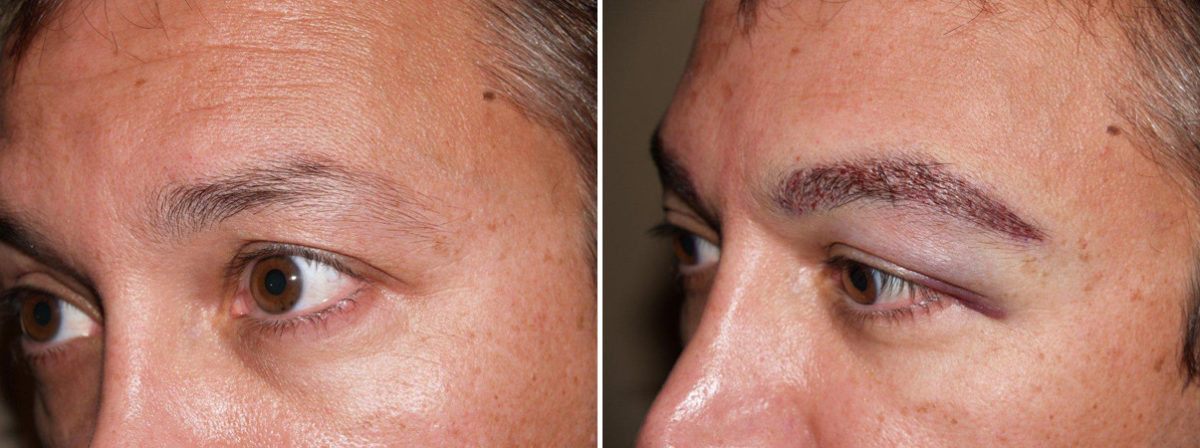 Eyebrow Transplantation before and after photos in Miami, FL, Patient 15787
