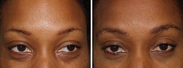 Eyebrow Transplantation before and after photos in Miami, FL, Patient 15794