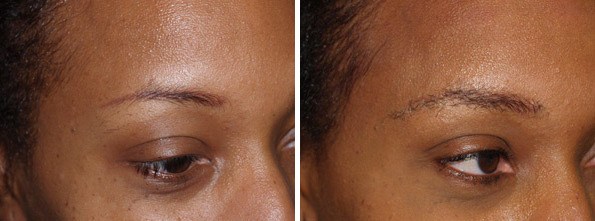 Eyebrow Transplantation before and after photos in Miami, FL, Patient 15794
