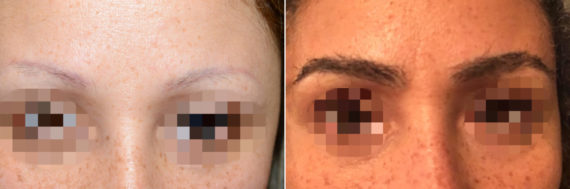 Eyebrow Transplantation before and after photos in Miami, FL, Patient 15808