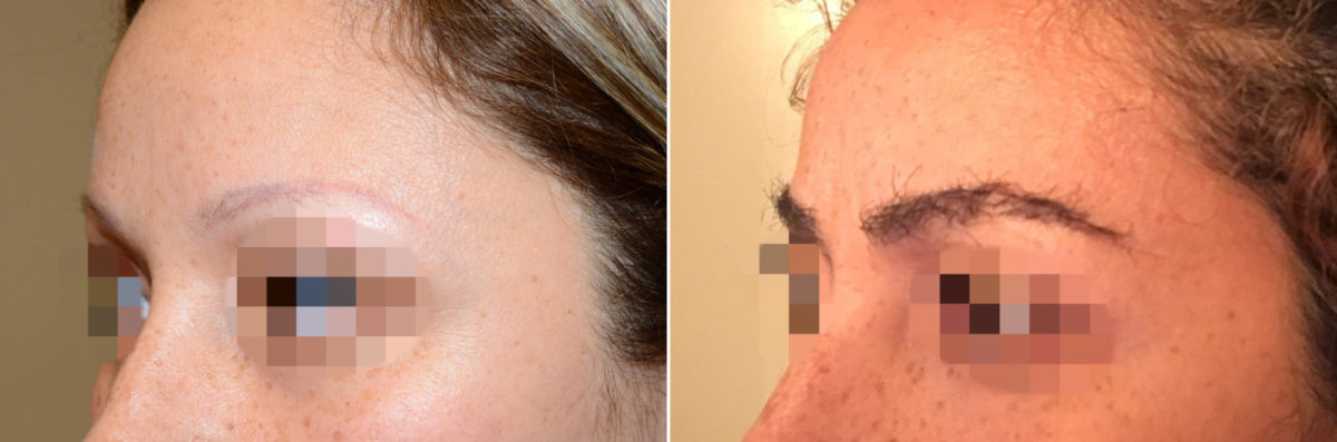 Eyebrow Transplantation before and after photos in Miami, FL, Patient 15808