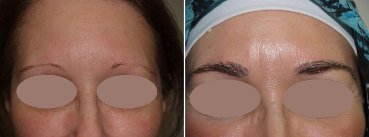 Eyebrow Transplantation before and after photos in Miami, FL, Patient 15815