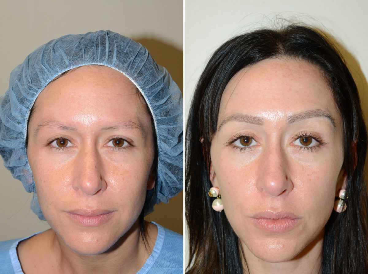 Eyebrow Transplantation before and after photos in Miami, FL, Patient 15825