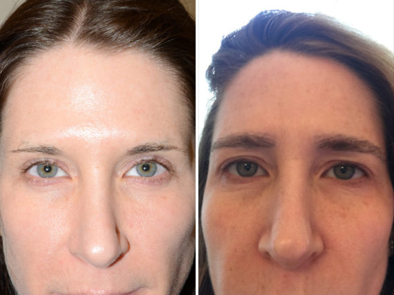 Eyebrow Transplantation before and after photos in Miami, FL, Patient 15834