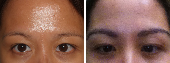 Eyebrow Transplantation before and after photos in Miami, FL, Patient 15837