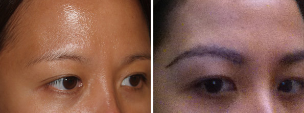 Eyebrow Transplantation before and after photos in Miami, FL, Patient 15837