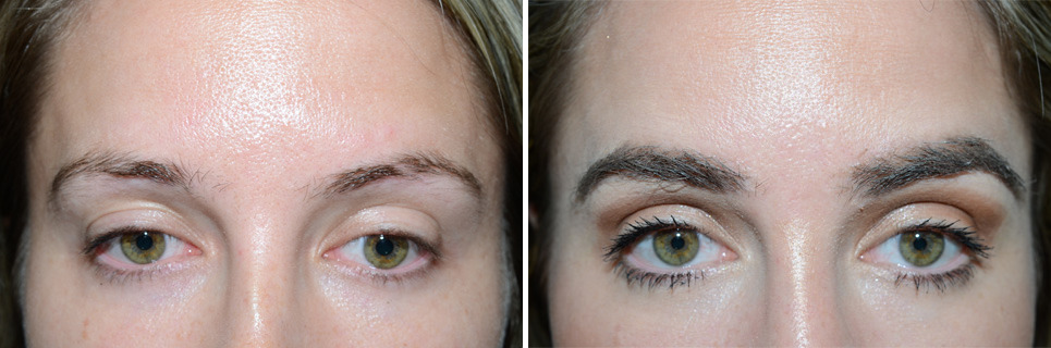 Eyebrow Transplantation before and after photos in Miami, FL, Patient 15844