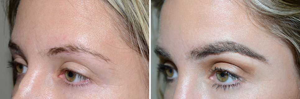 Eyebrow Transplantation before and after photos in Miami, FL, Patient 15844