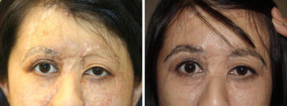 Eyebrow Transplantation before and after photos in Miami, FL, Patient 15854