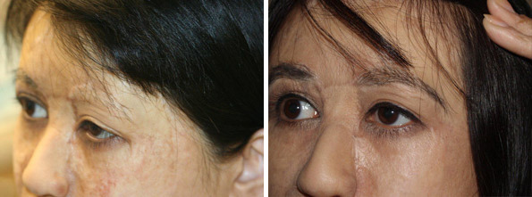 Eyebrow Transplantation before and after photos in Miami, FL, Patient 15854