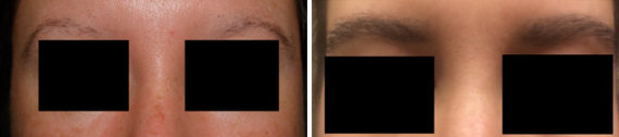Eyebrow Transplantation before and after photos in Miami, FL, Patient 15861
