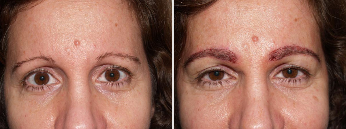 Eyebrow Transplantation before and after photos in Miami, FL, Patient 15879