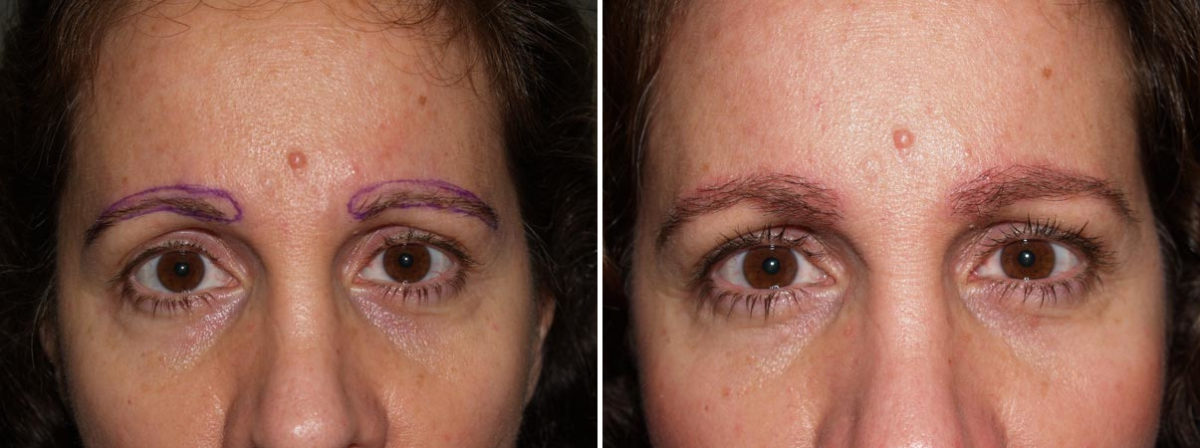 Eyebrow Transplantation before and after photos in Miami, FL, Patient 15879