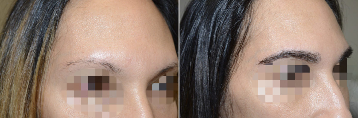 Eyebrow Transplantation before and after photos in Miami, FL, Patient 15923